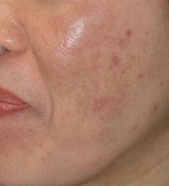 Laser Treatment